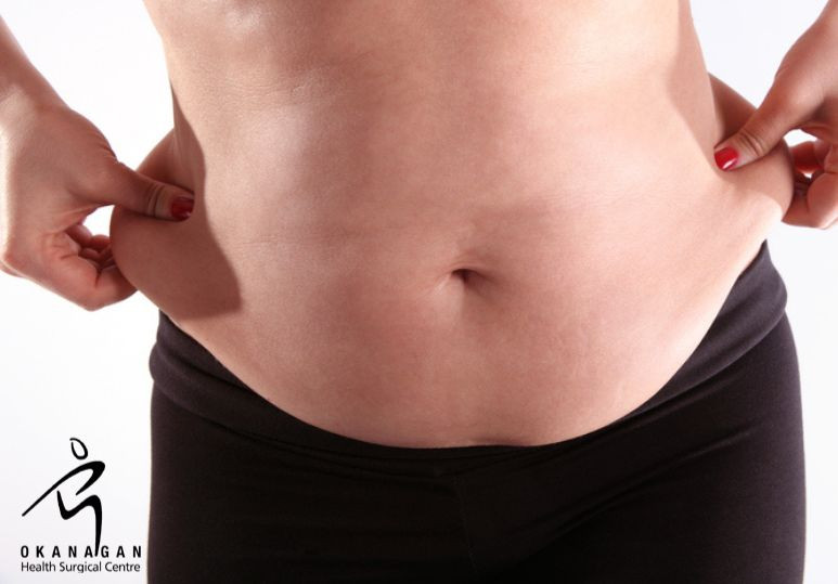 Abdominal Plastic Surgery: Am I A Good Candidate For A Tummy Tuck?